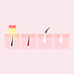 XEMOS SILHOUETTE LASER HAIR REMOVER